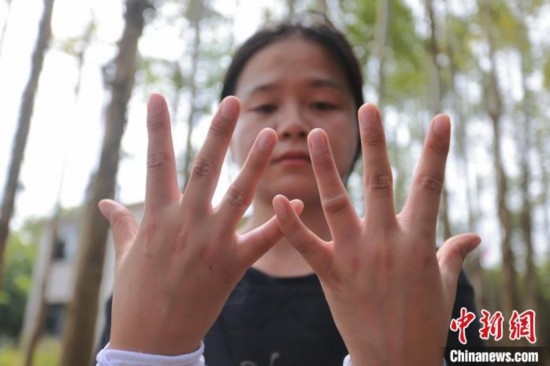 吳素英展示被蜜蜂蜇過的雙手。湯曉逵 攝