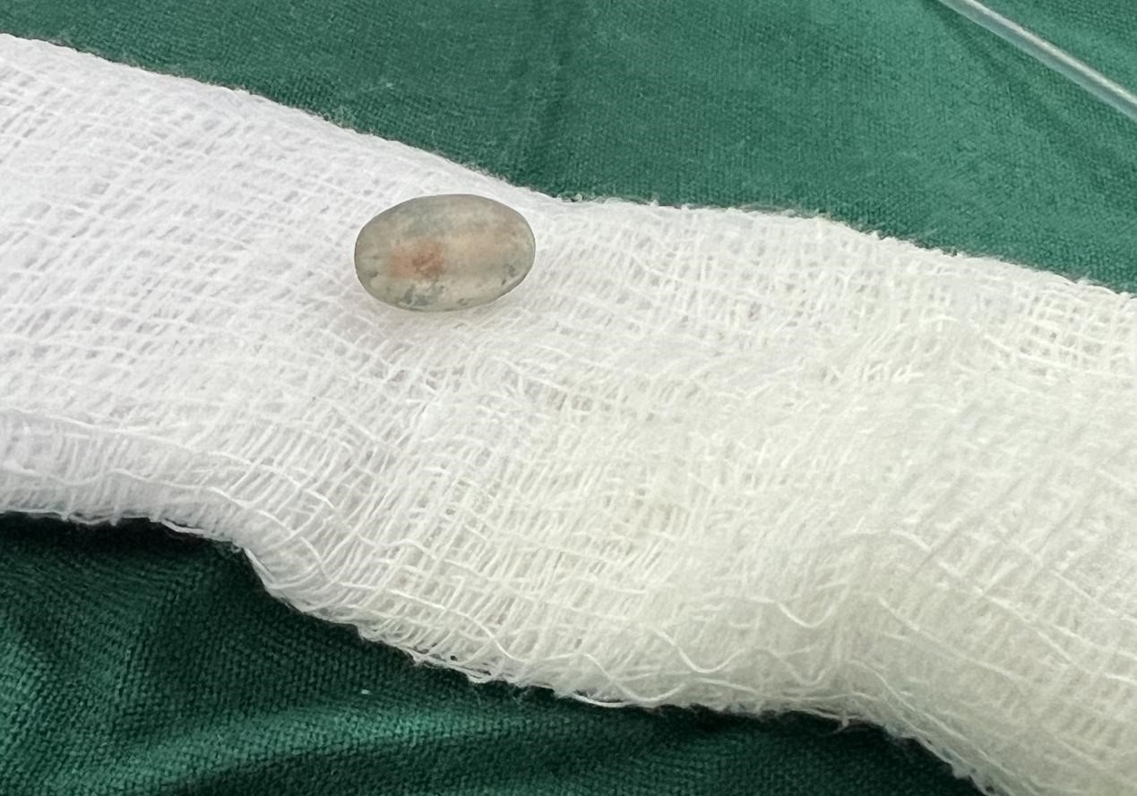 被取出的異物。中國(guó)援桑醫(yī)療隊(duì)供圖