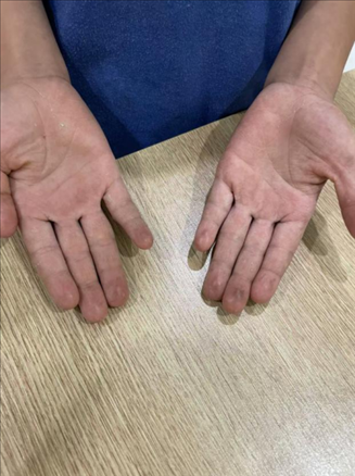 9歲小學(xué)生長期拍煙卡，手部粗糙長繭。受訪者供圖